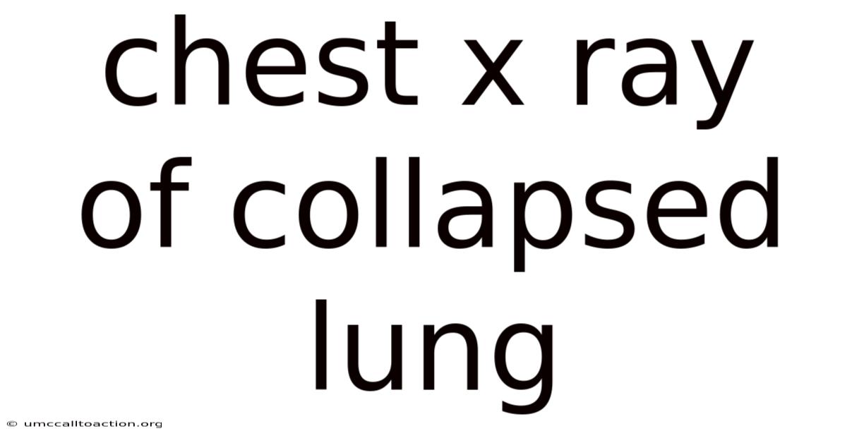 Chest X Ray Of Collapsed Lung