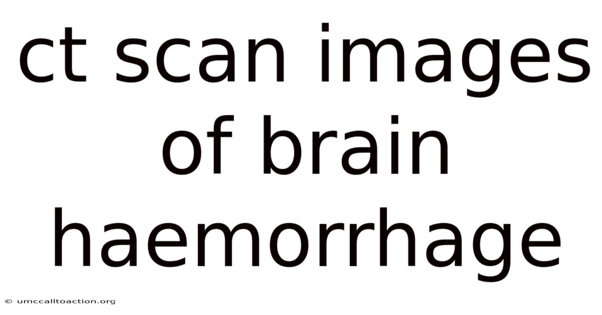Ct Scan Images Of Brain Haemorrhage