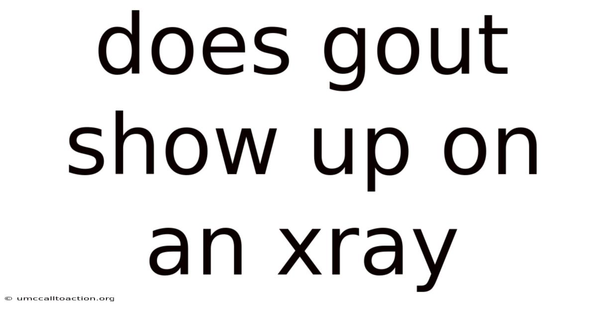 Does Gout Show Up On An Xray