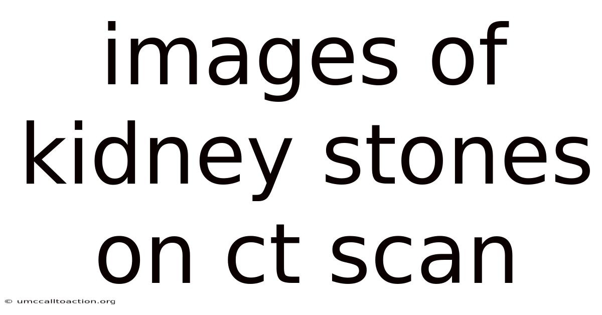 Images Of Kidney Stones On Ct Scan