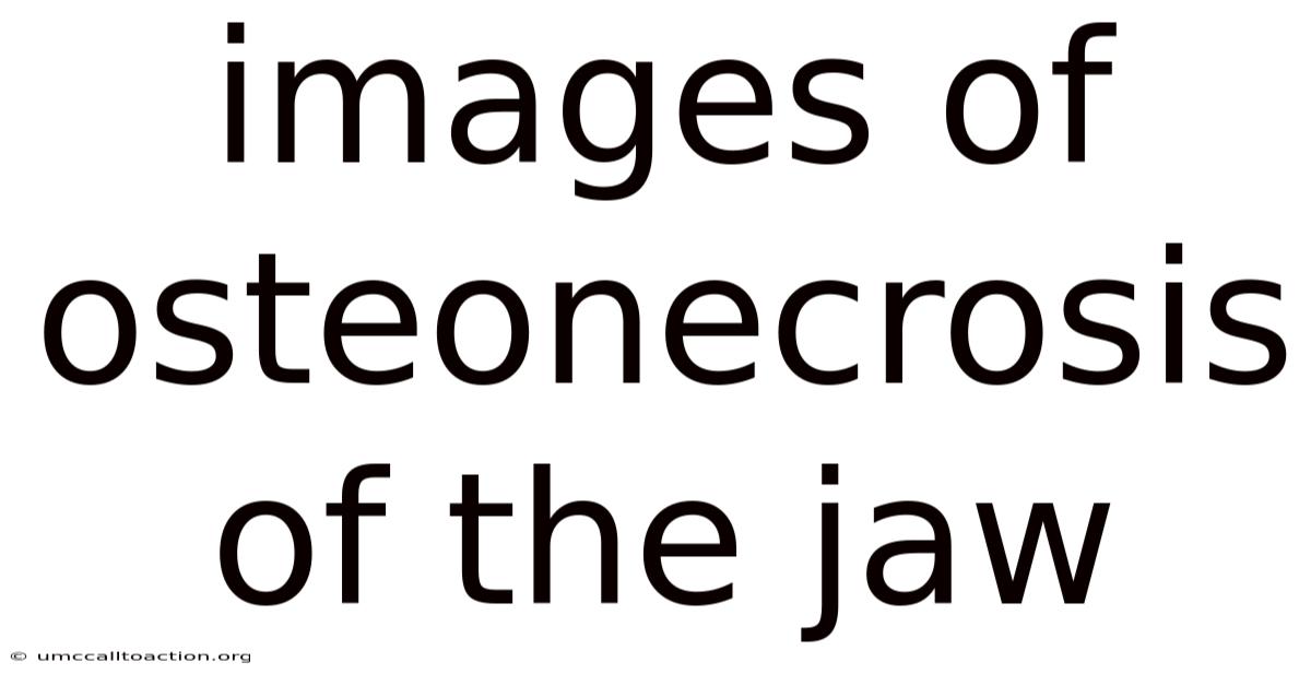 Images Of Osteonecrosis Of The Jaw
