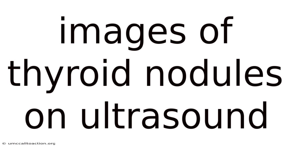 Images Of Thyroid Nodules On Ultrasound