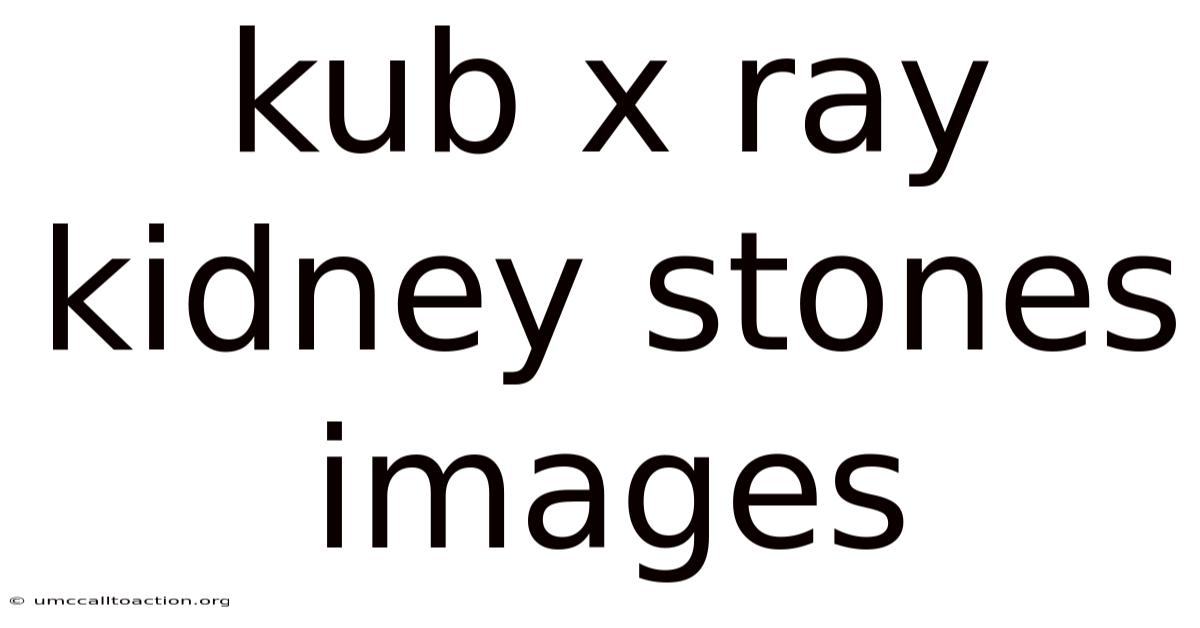 Kub X Ray Kidney Stones Images