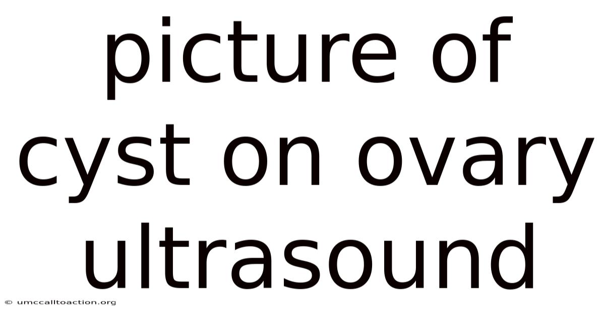 Picture Of Cyst On Ovary Ultrasound