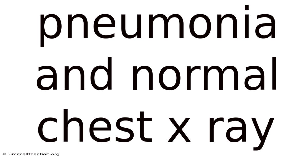 Pneumonia And Normal Chest X Ray