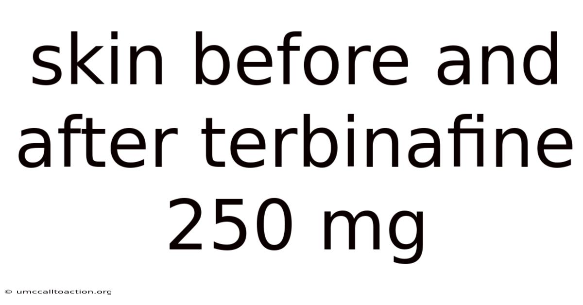 Skin Before And After Terbinafine 250 Mg