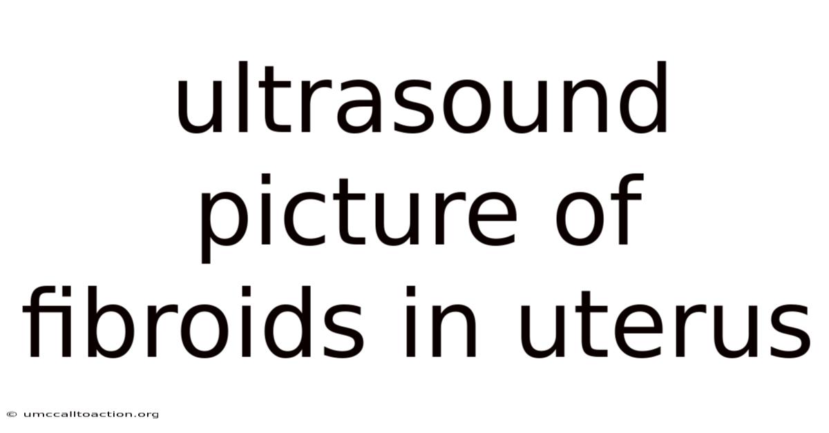 Ultrasound Picture Of Fibroids In Uterus